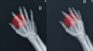 Value of Injured Finger or Hand After Crash